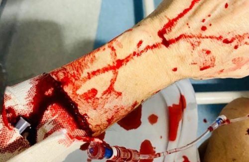 Joseph Stanislav's arm injuries.