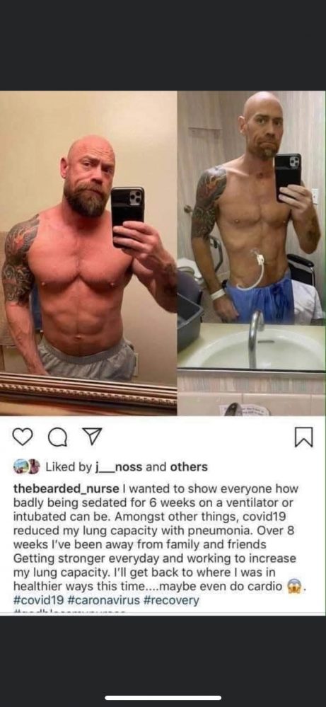 RN Mike Schultz posted the dramatic before-and-after photos from his fight with COVID-19